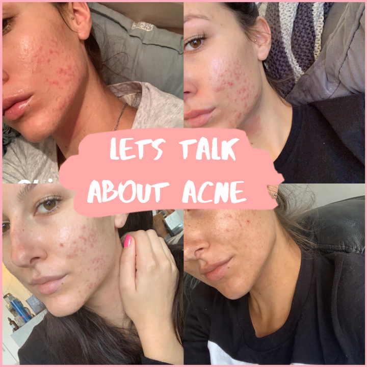 Lets talk about Acne